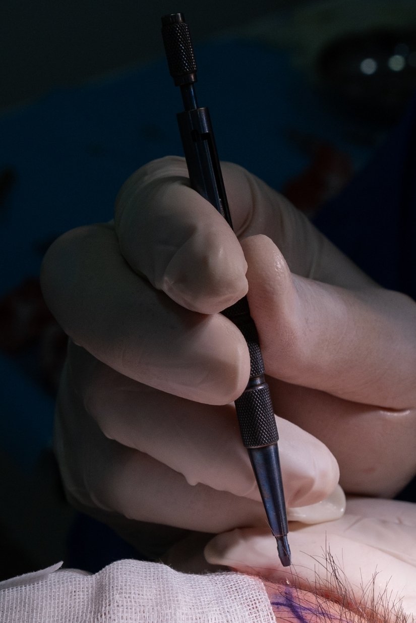 Greffe capillaire paris