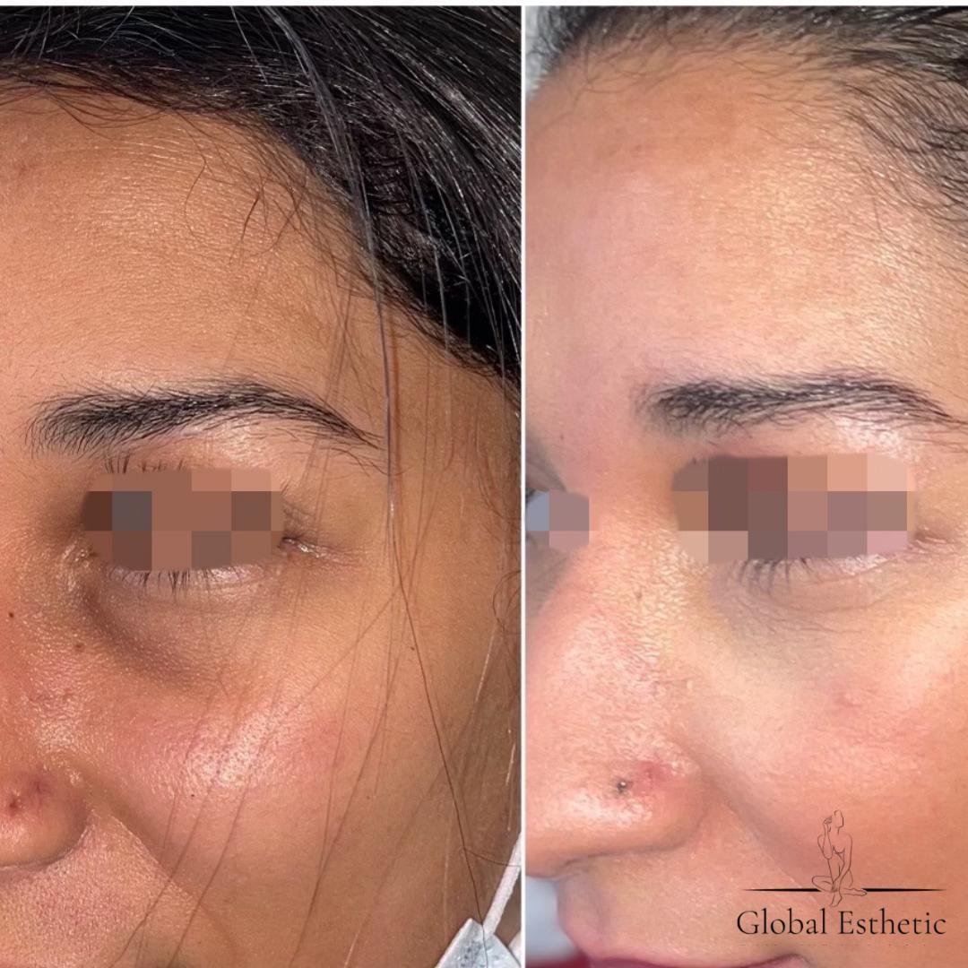 resultat microfat paris